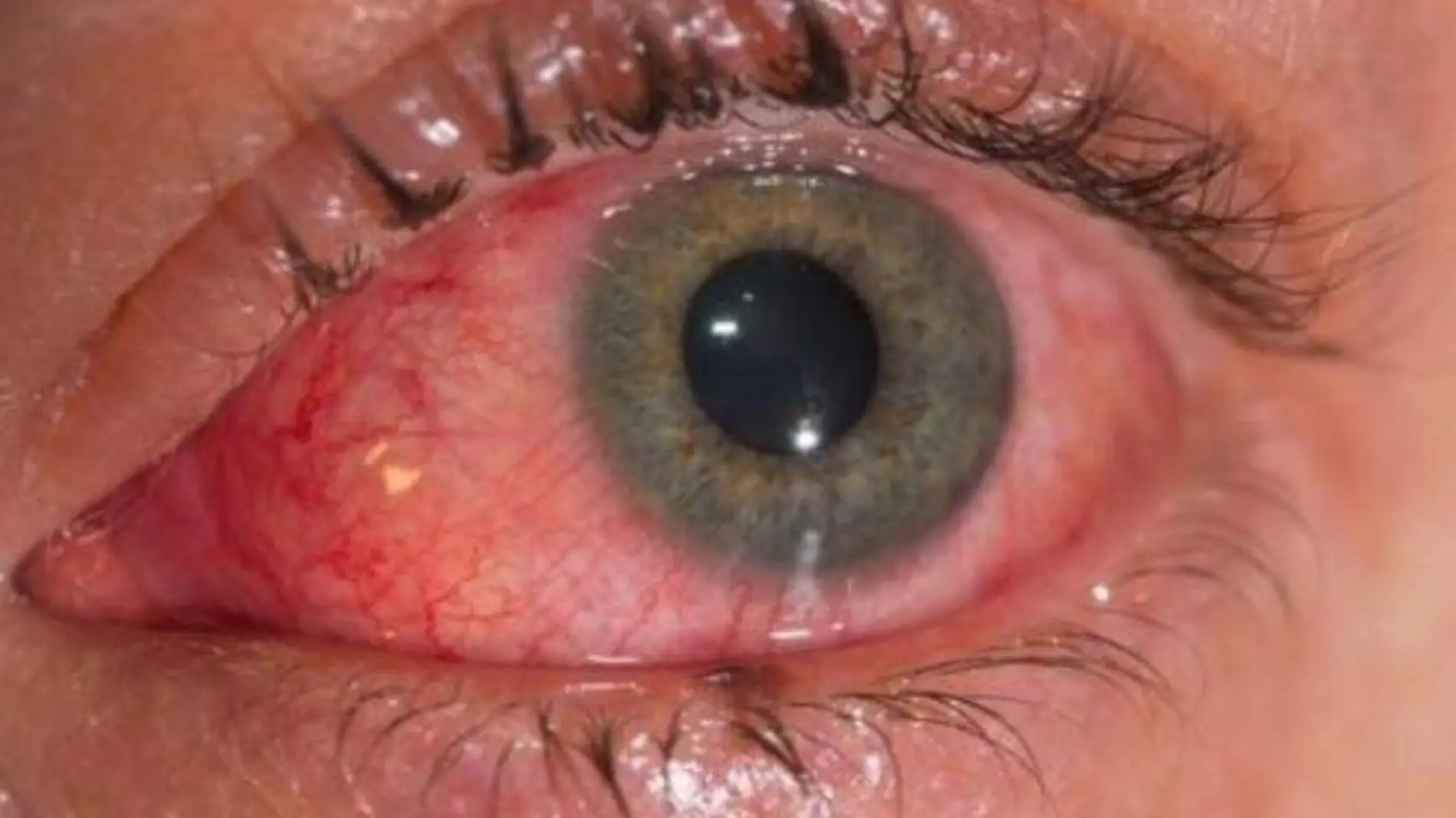 Ojo rojo drogas conjuntivitis